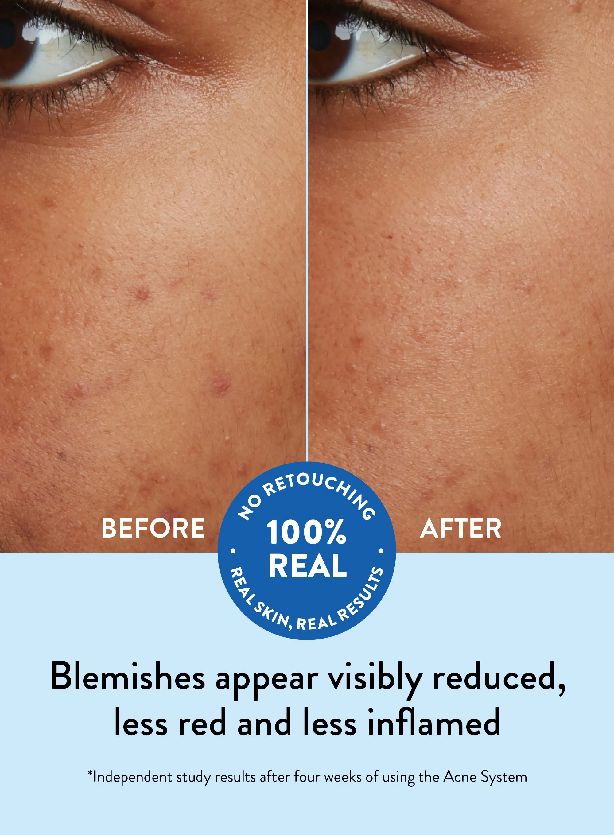 Acne Oil-Free Moisturizer